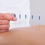 Acupuncture(with DR)